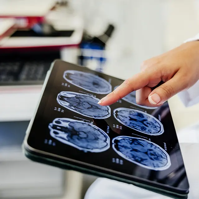 Skjerm med MRI-resultater av en skannet hjerne