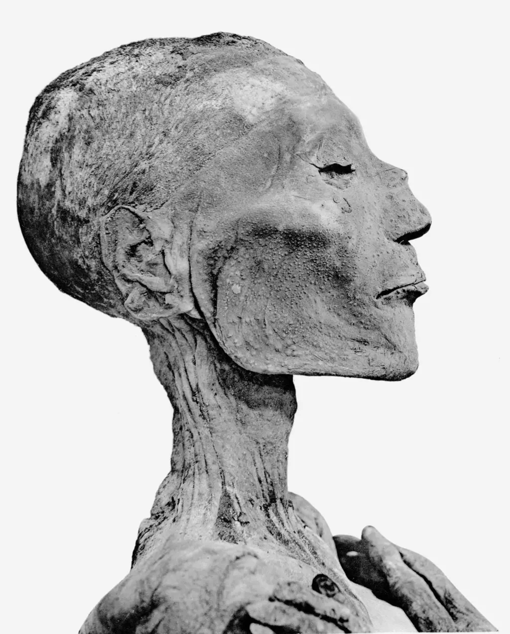 Ramses V skeletthode